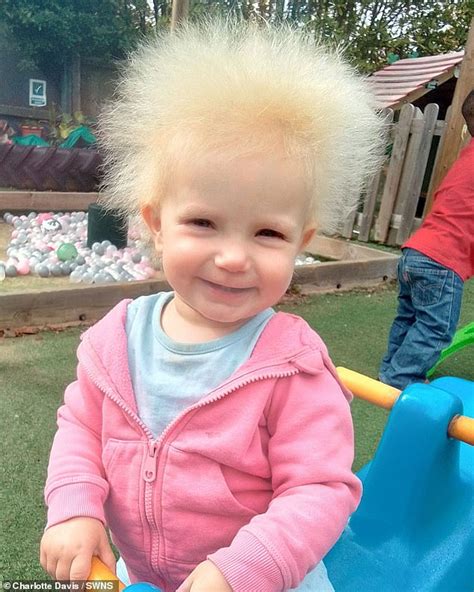 einstein syndrome|einstein hair syndrome.